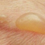 Curas de Ampollas