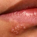 Tratar los Herpes