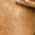 Hacer Desaparecer las Manchas en la Piel